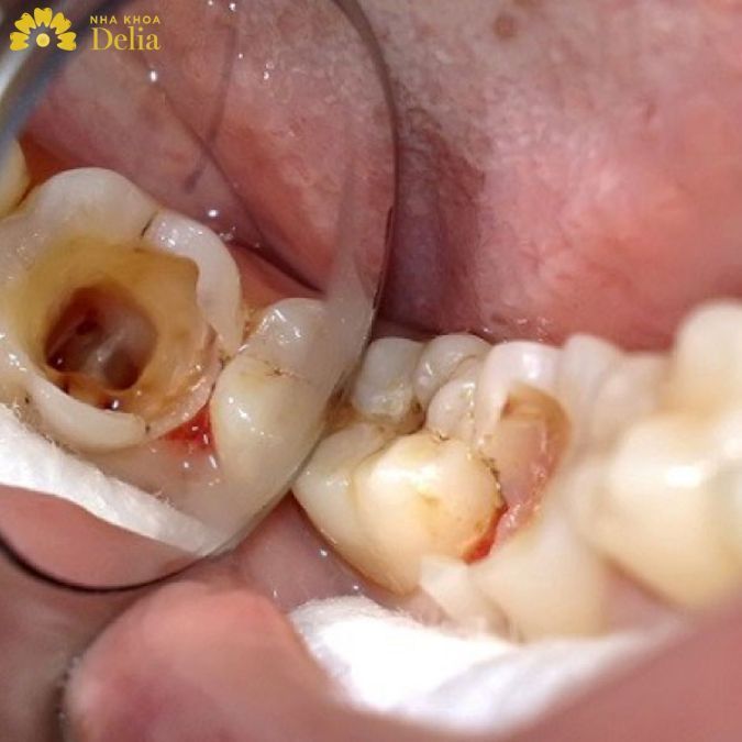 Răng chữa tủy nên bọc răng sứ để cải thiện chức năng ăn nhai