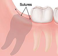 wisdom tooth removal in Newmarket