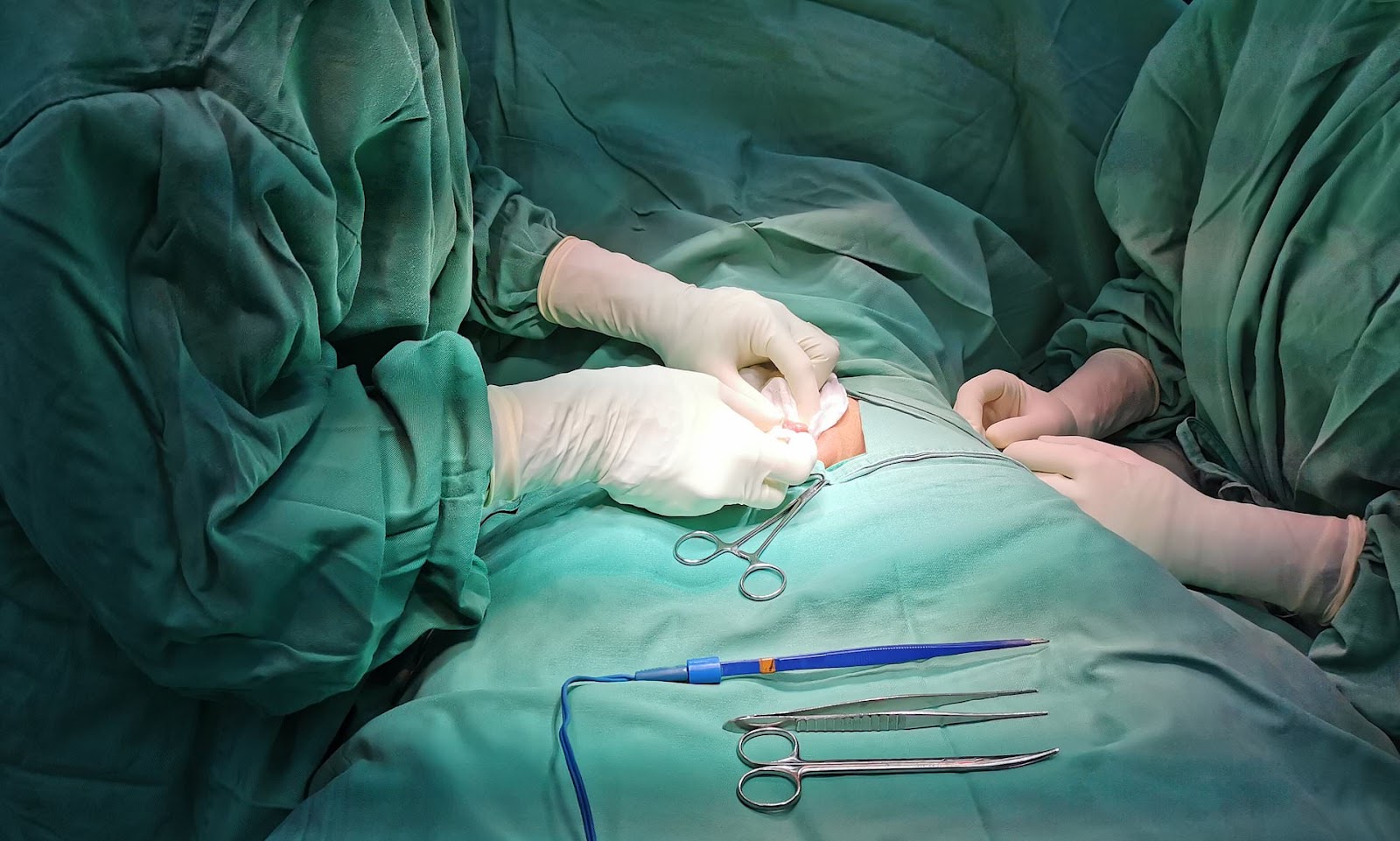 Người bệnh cần chú ý chăm sóc vết thương sau phẫu thuật cắt bao quy đầu