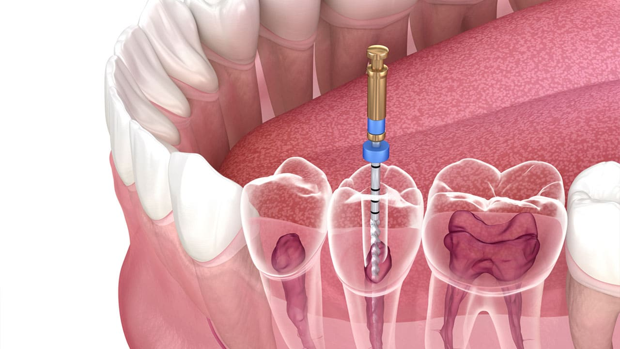 Root Canal Therapy Procedure 