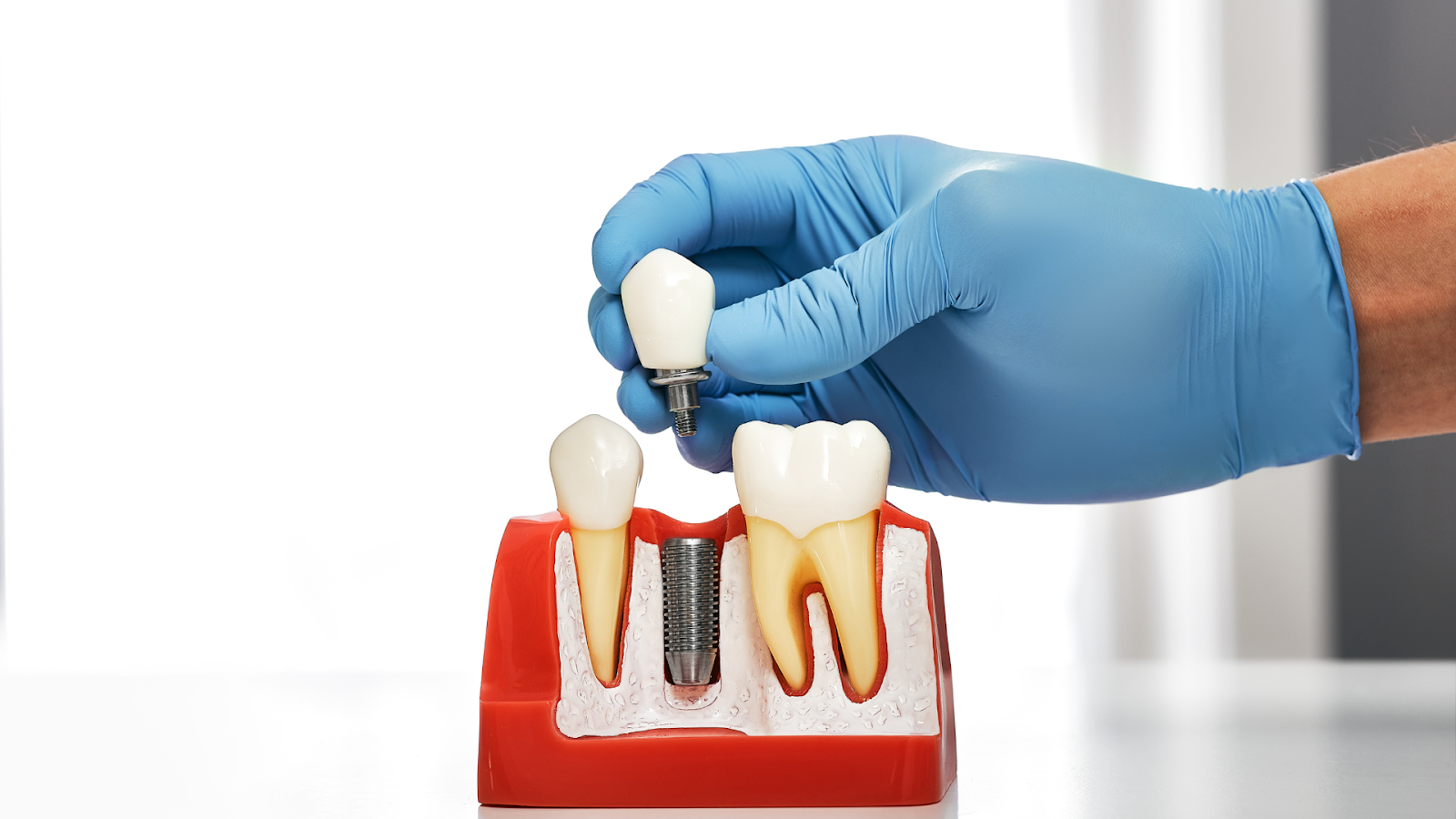 Dental Implant Marketing – Help Them Reclaim Their Natural Beauty!