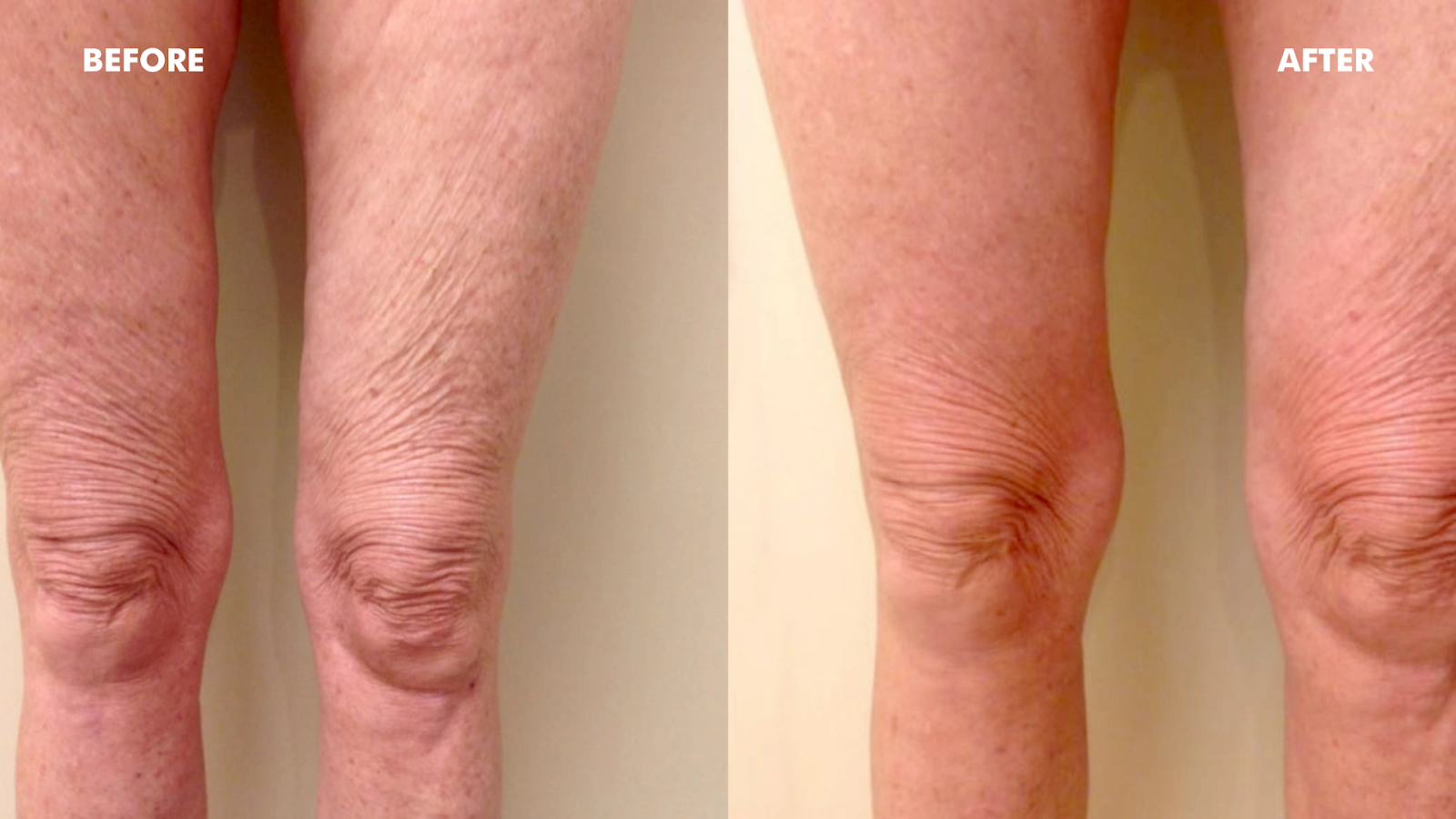 Before and after of knees. 