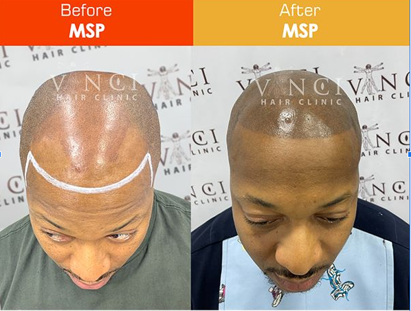 Micro Scalp Pigmentation (MSP) is a technique that mimics pigments to achieve a shaved or low-cut look on your scalp, matching your natural hair colour.