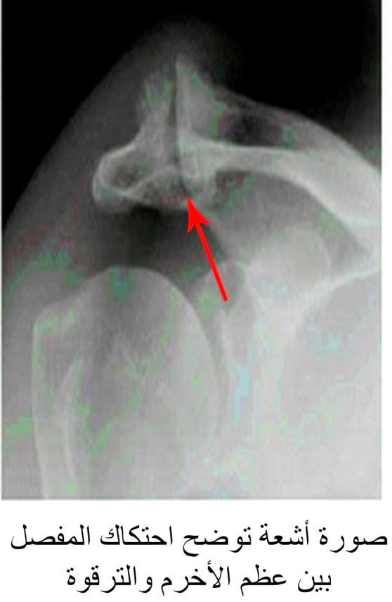 E:\Documents and Settings\USER\Desktop\كبار السن\أشعة ac joint.jpg