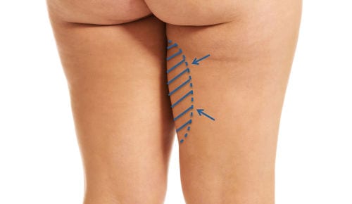 Liposucción de piernas: ¿Qué implica?