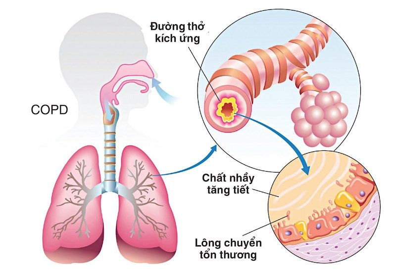 Triệu chứng bệnh phổi 3
