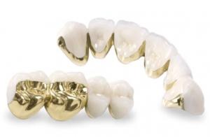 Các loại răng sứ kim loại quý có chi phí tương đối cao