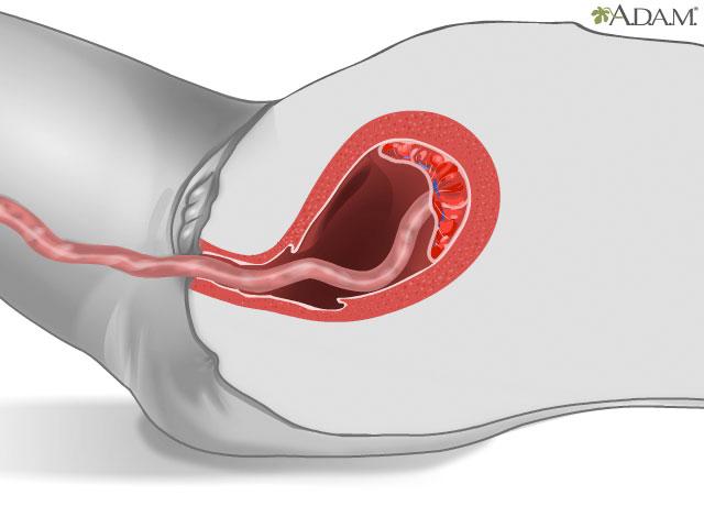 HIE Multimedia - Placenta delivery