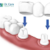 BIẾN CHỨNG DO CẦU RĂNG SỨ CÓ G Y NGUY HIỂM KHÔNG?