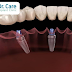 Phục Hồi Nụ Cười Với Cấy Ghép Implant All-on-4