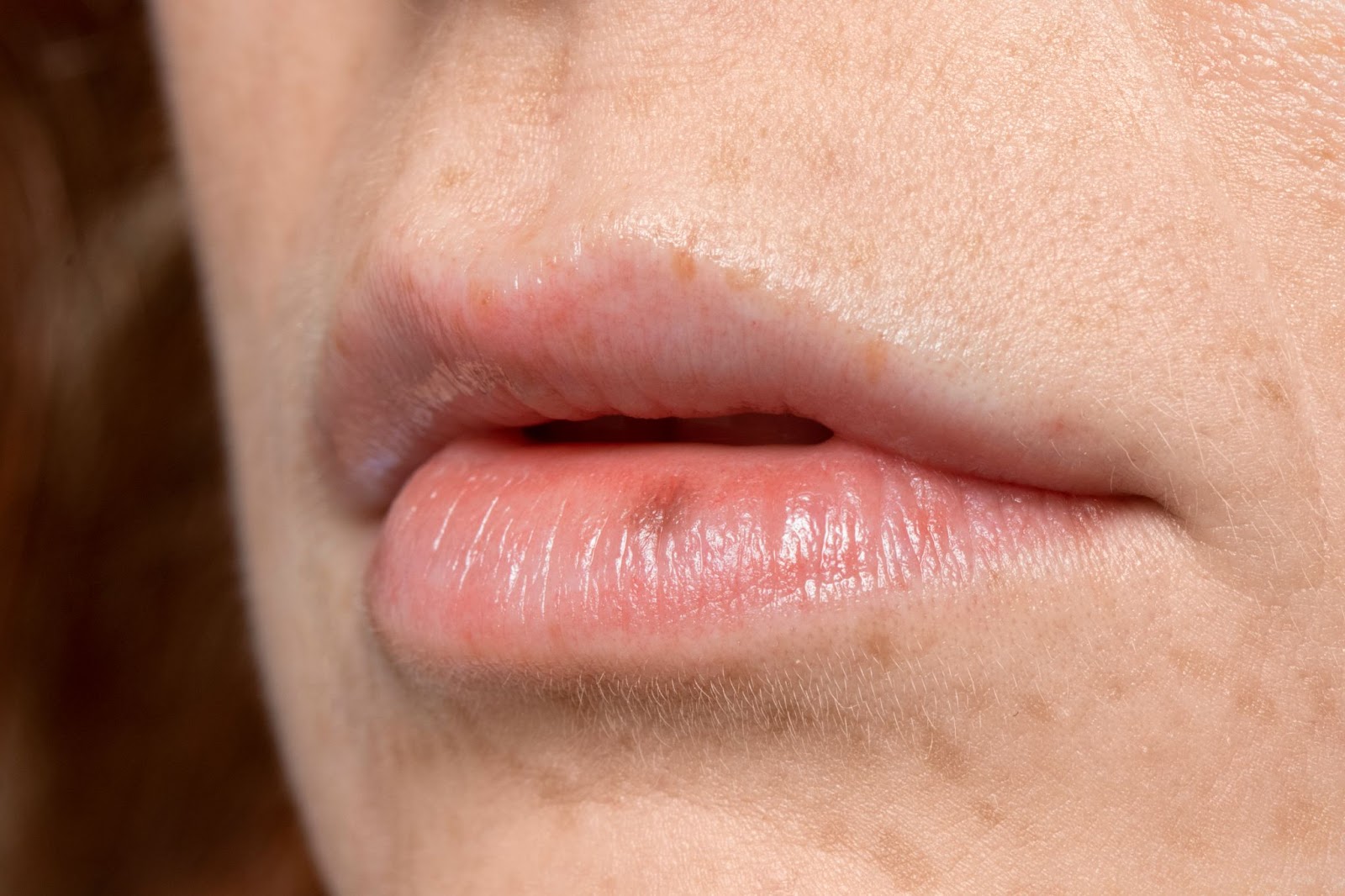 what to do for sunburned lips
