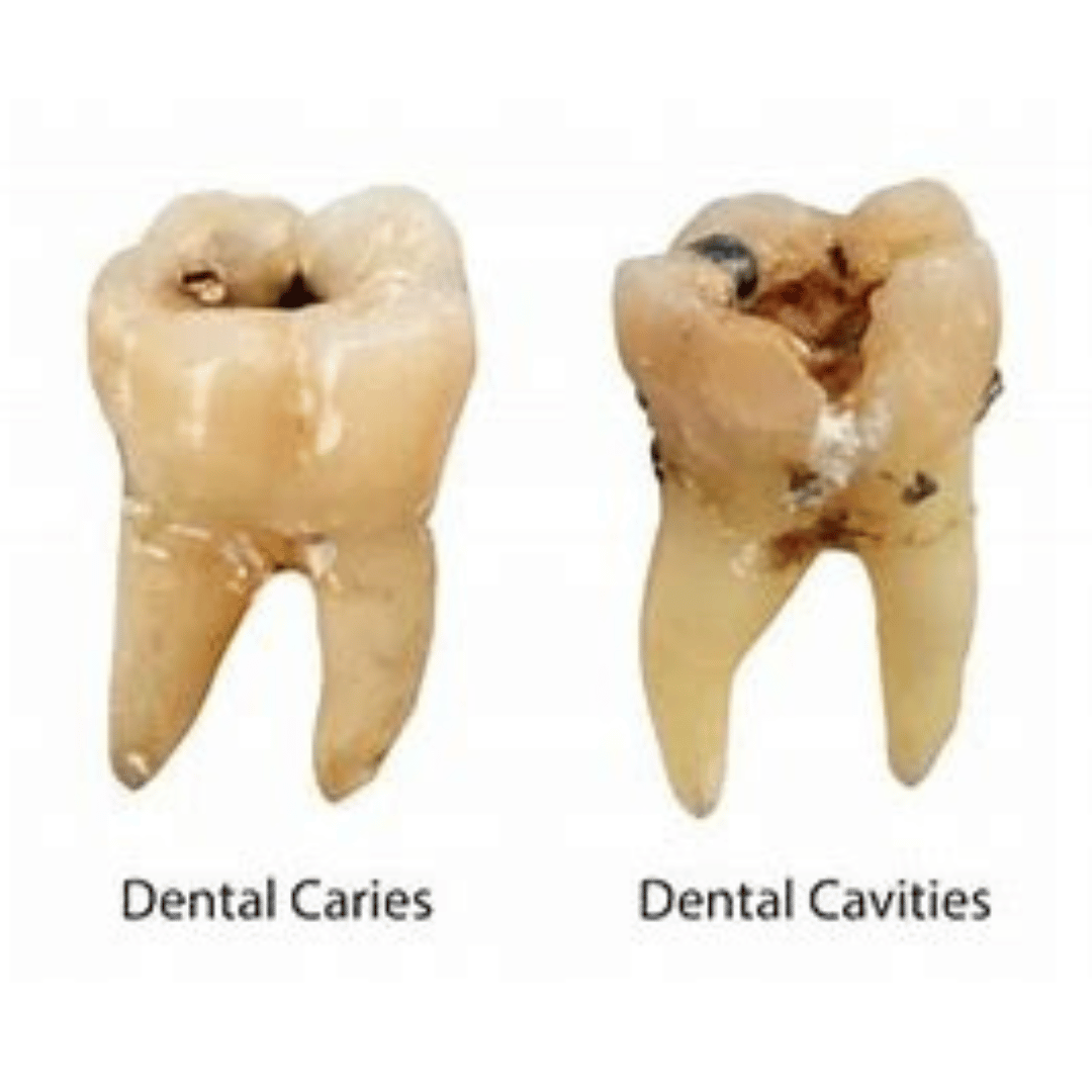 Cavity on Side of Tooth