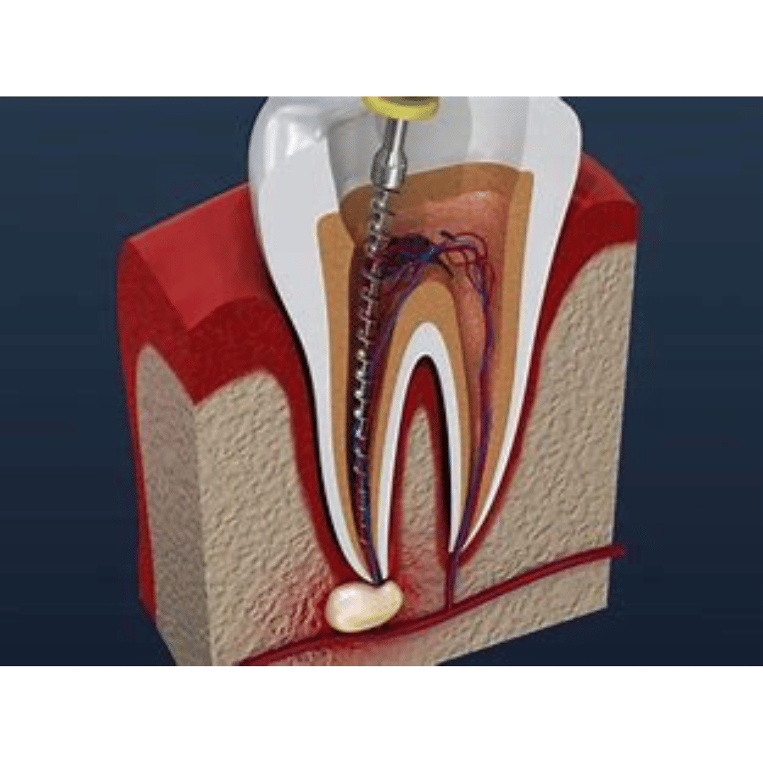 What is Root Canal Therapy