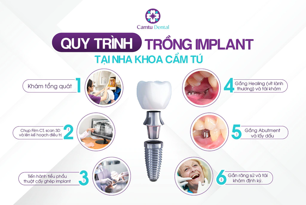 Infographic mô tả chi tiết quy trình cấy ghép implant tại Nha khoa Camtu, bao gồm các bước từ thăm khám ban đầu, chụp CT, phẫu thuật, đặt nắp lành thương, gắn abutment cho đến gắn mão răng cuối cùng.
