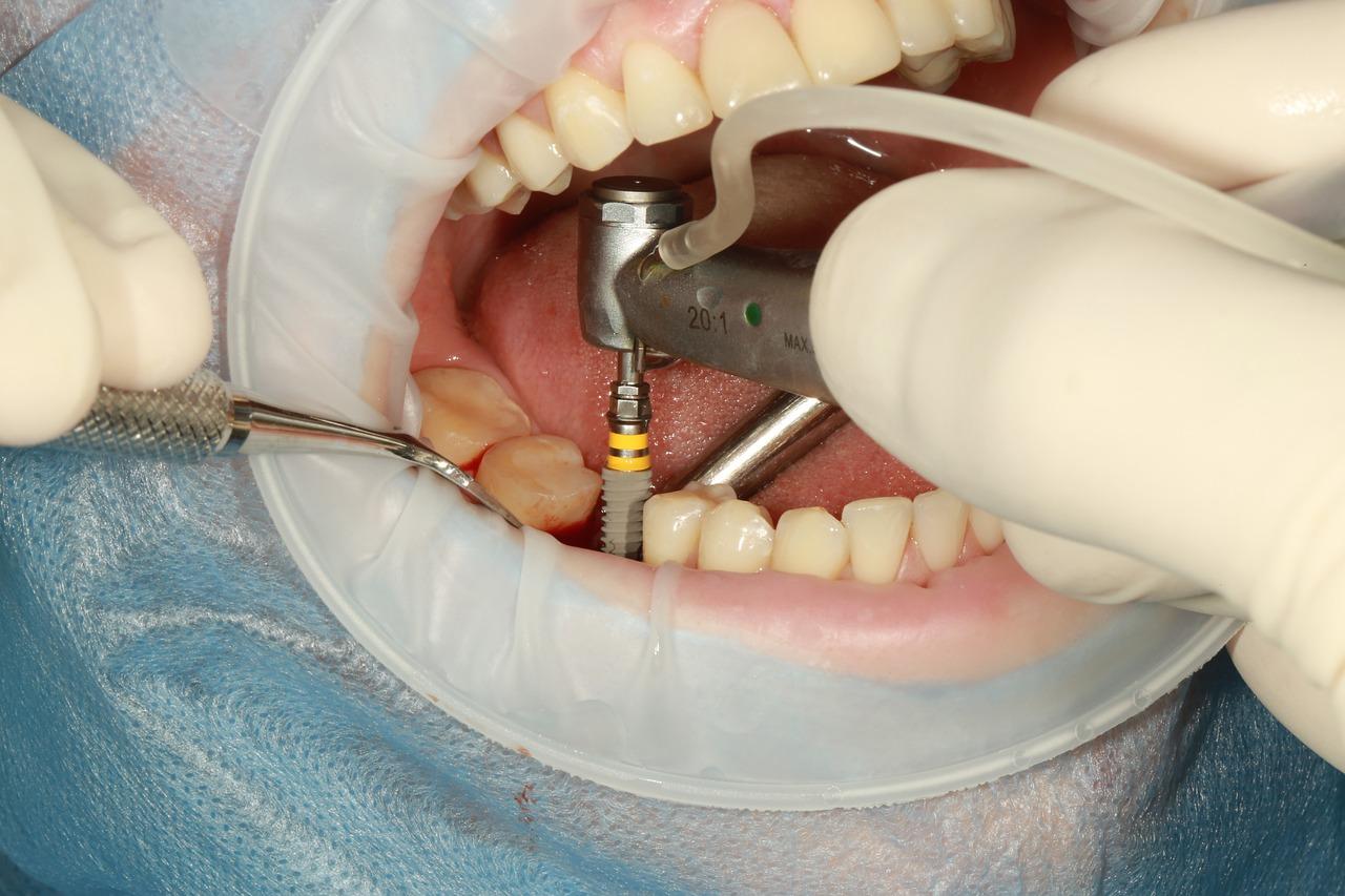implementacja implantu zębowego