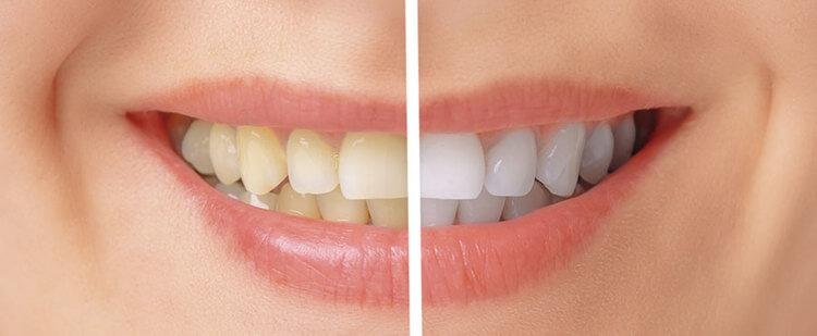 teeth whitening services in North York