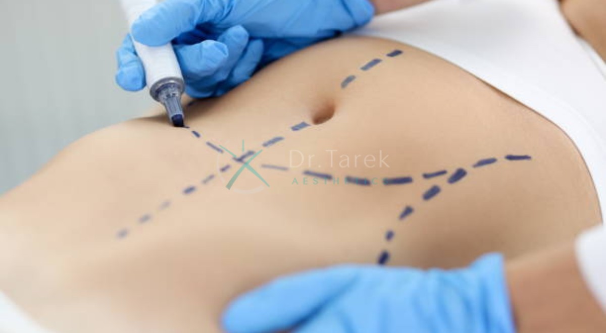 How Much Liposuction Can Be Done With A Tummy Tuck