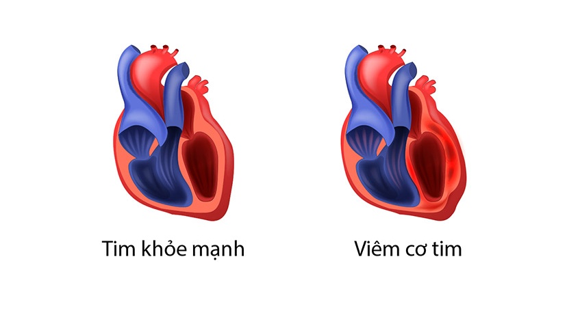 Xét nghiệm troponin T là gì? Ý nghĩa của xét nghiệm troponin T? 4