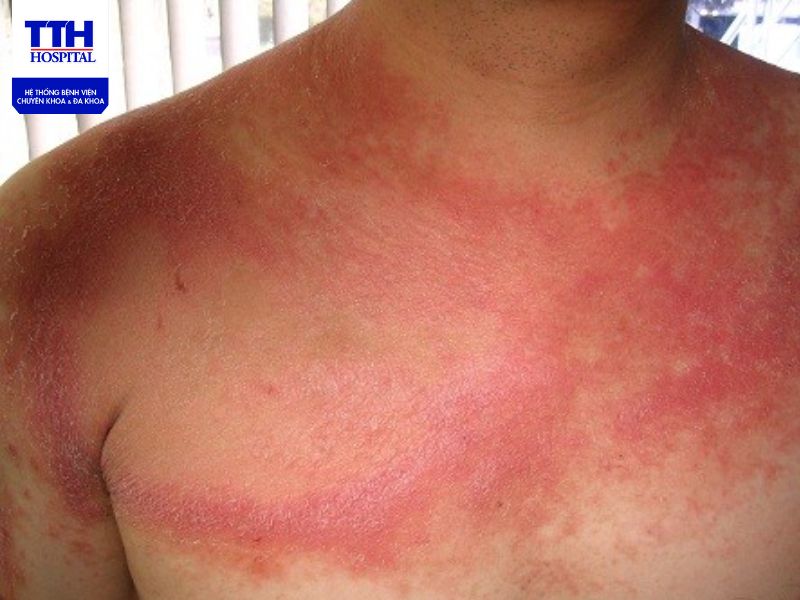 Triệu chứng của lupus ban đỏ hệ thống có thể thay đổi từ người này sang người khác