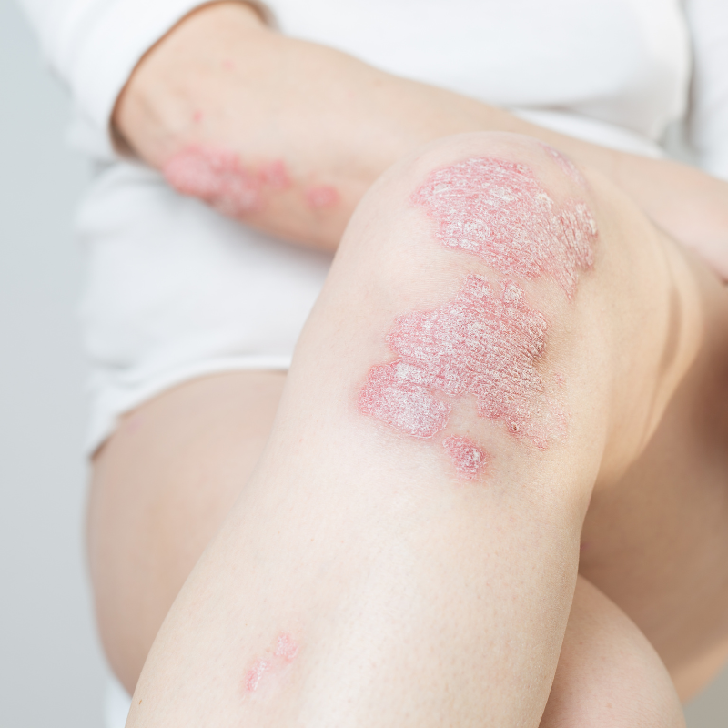 Manage Psoriasis effectively by visiting a dermatologist.
