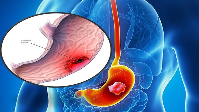 Xét nghiệm CA 72-4 và ý nghĩa trong chẩn đoán ung thư 2