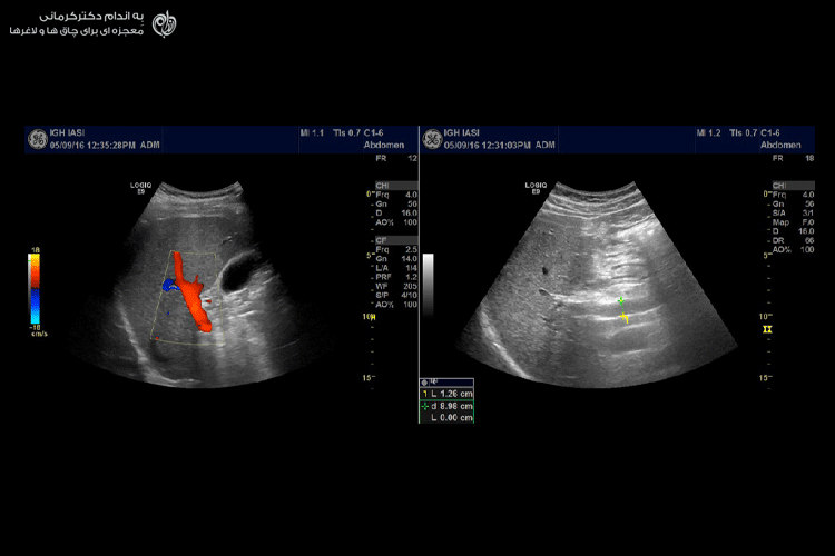 تصویر برداری دوپلر برای تشخیص کبد چرب