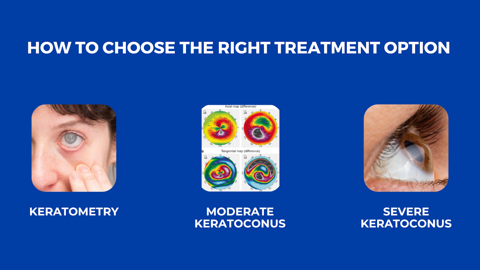 Keratoconus Treatment Options Navigating The Path To Clear Vision