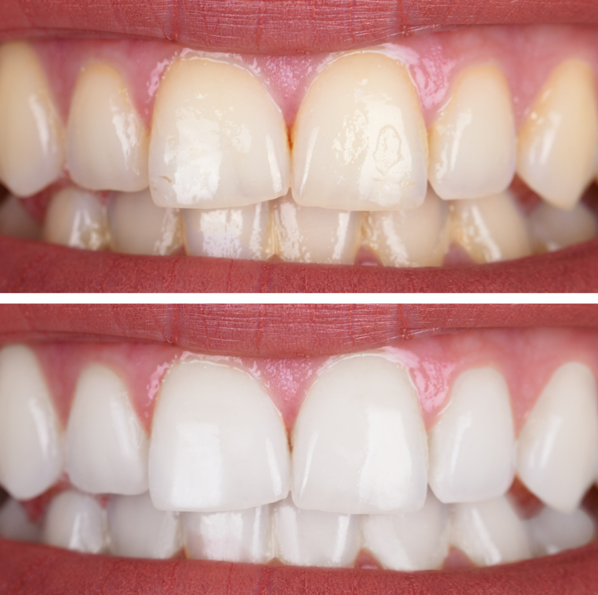 Teeth whitening before and after 