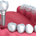 Biện pháp trồng răng Implant thay thế khi bị sâu răng số 7