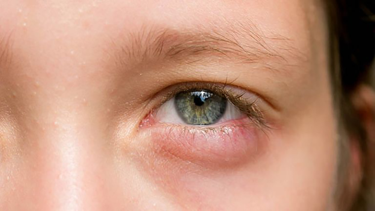 Thuốc nhỏ mắt Neodex được chỉ định trong những trường hợp bị viêm nhiễm vùng mắt