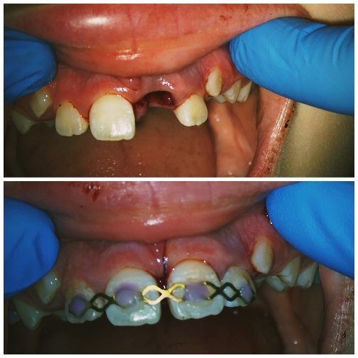 Obraz zawierający Ząb, osoba, zęby, dentystyka

Opis wygenerowany automatycznie