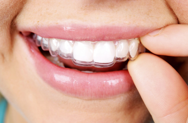 clear aligners
