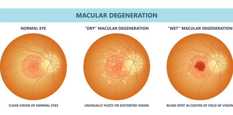 A diagram of different types of eye diseasesDescription automatically generated