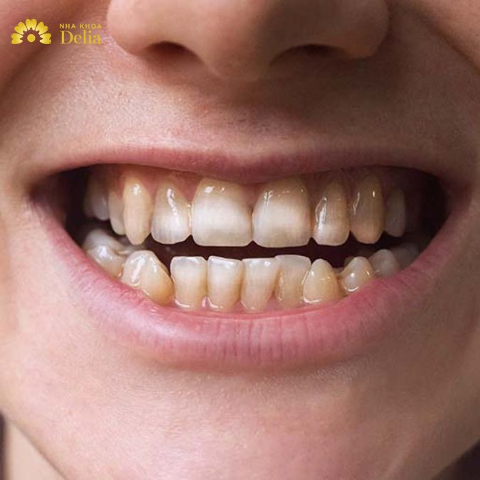 Bạn có thể phát hiện men răng bị hỏng, yếu đi nếu như gặp phải tình trạng ê buốt kéo dài