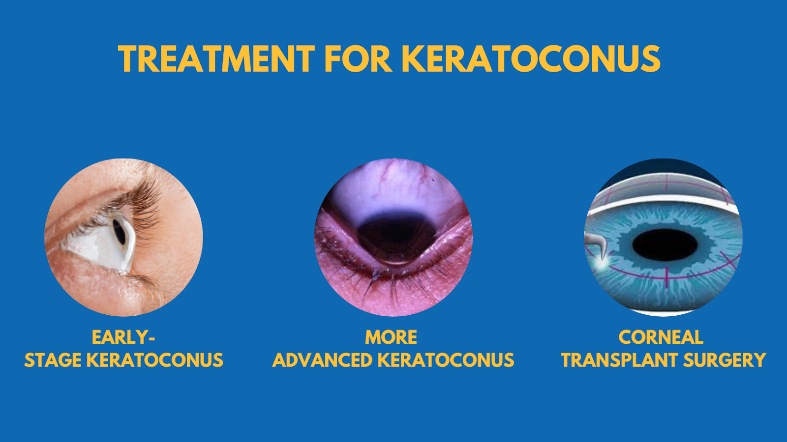 Understanding Keratoconus Symptoms Causes And Treatment Options