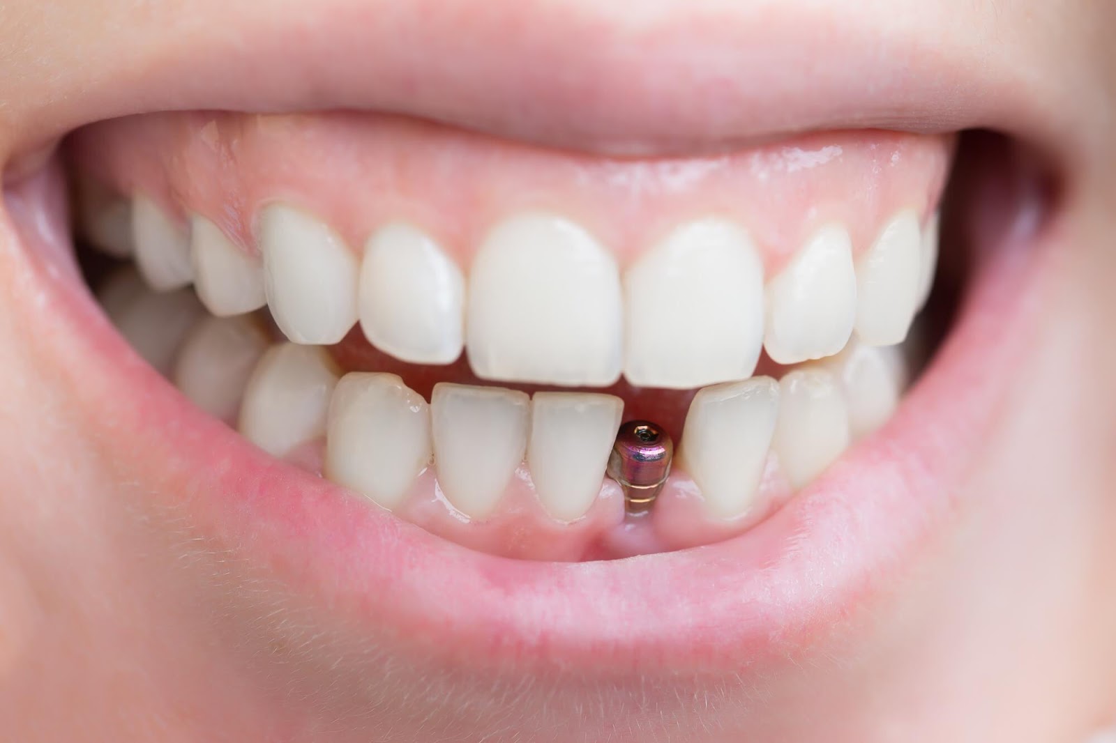 Kiedy wstawić implant po usunięciu zęba