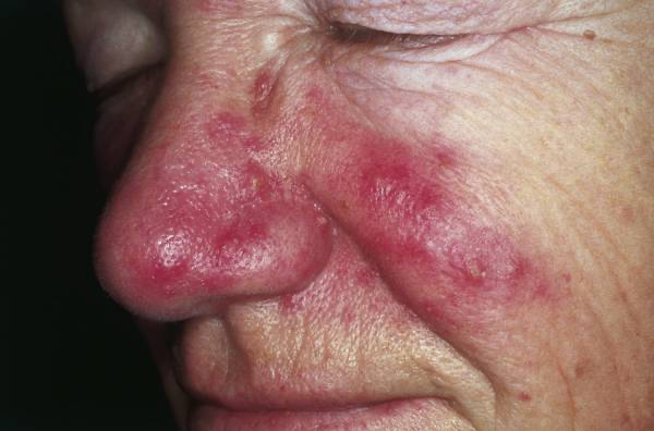 5 Penyebab Mata Bintitan Tak Kunjung Sembuh yang Sering Disepelekan - Menderita Penyakit Kulit Rosacea