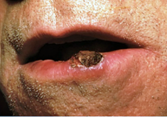 carcinoma de células escamosas en el labio