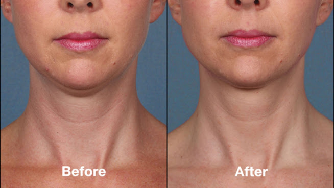 kybella-before-and-after