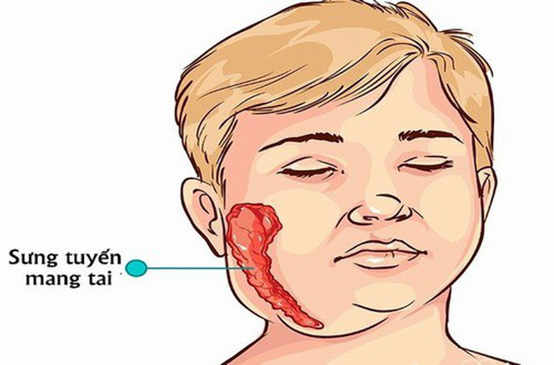 Virus thuộc họ Paramyxoviridae là nguyên nhân gây ra bệnh quai bị