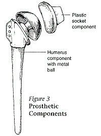illustration of a shoulder joint replacement