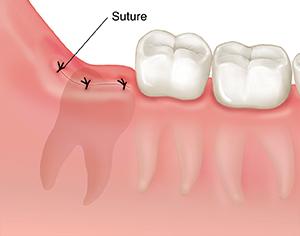wisdom tooth removal in Newmarket