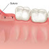 General Information About Wisdom Tooth Suture Removal
