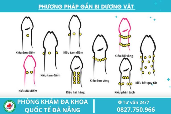 Phương pháp gắn bi dương vật